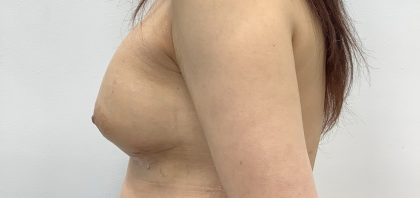 Breast Augmentation Before & After Patient #3229