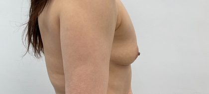 Breast Augmentation Before & After Patient #3229