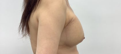 Breast Augmentation Before & After Patient #3229