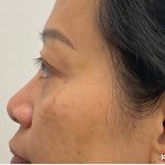 Non-Surgical Rhinoplasty Before & After Patient #3221