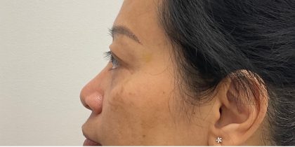 Non-Surgical Rhinoplasty Before & After Patient #3221