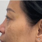 Non-Surgical Rhinoplasty Before & After Patient #3221