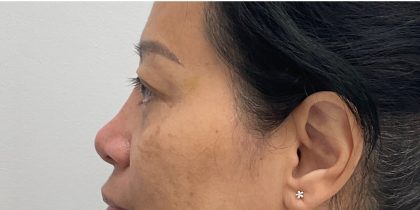 Non-Surgical Rhinoplasty Before & After Patient #3221