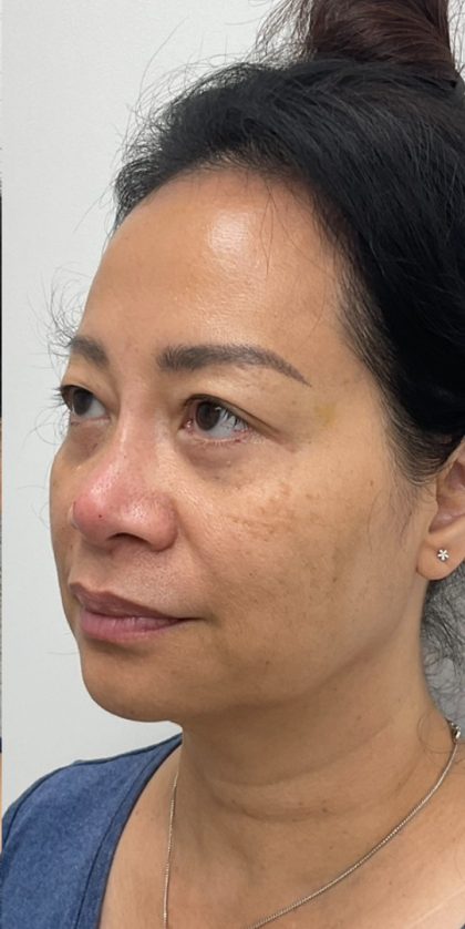 Non-Surgical Rhinoplasty Before & After Patient #3221