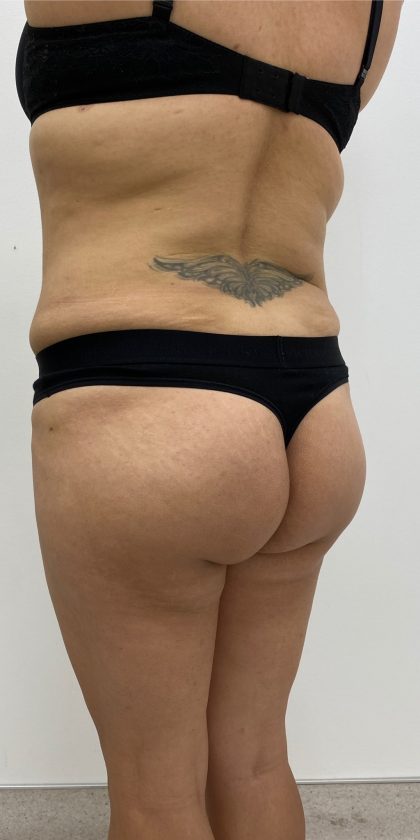 Fat Transfer Before & After Patient #3267