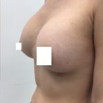 Breast Augmentation Before & After Patient #3230