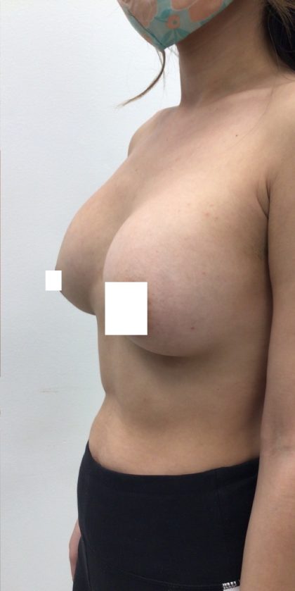 Breast Augmentation Before & After Patient #3230