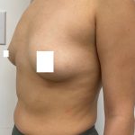 Breast Augmentation Before & After Patient #3230