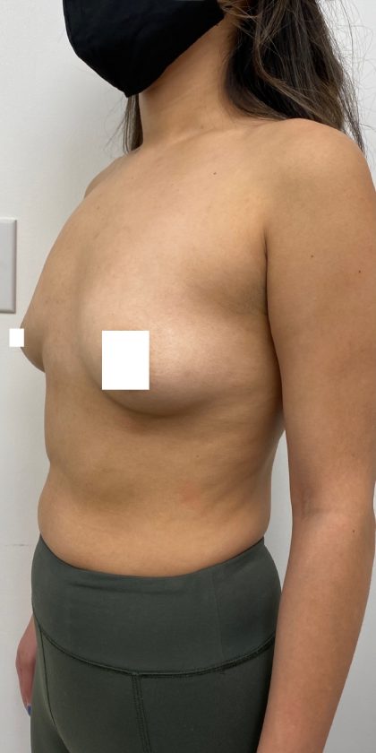 Breast Augmentation Before & After Patient #3230