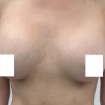 Breast Augmentation Before & After Patient #3230