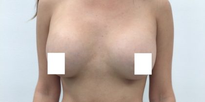 Breast Augmentation Before & After Patient #3230