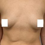 Breast Augmentation Before & After Patient #3230