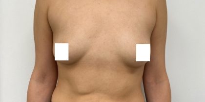 Breast Augmentation Before & After Patient #3230