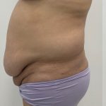 Fat Transfer Before & After Patient #3267