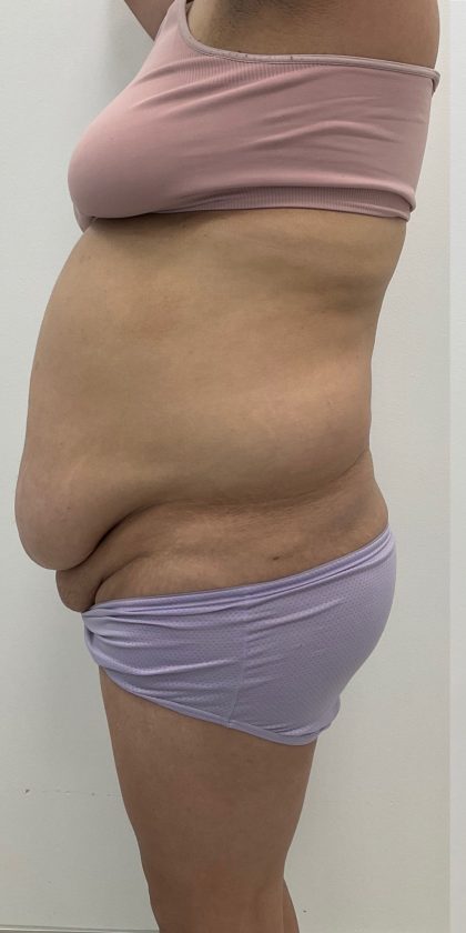 Fat Transfer Before & After Patient #3267