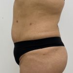 Fat Transfer Before & After Patient #3267