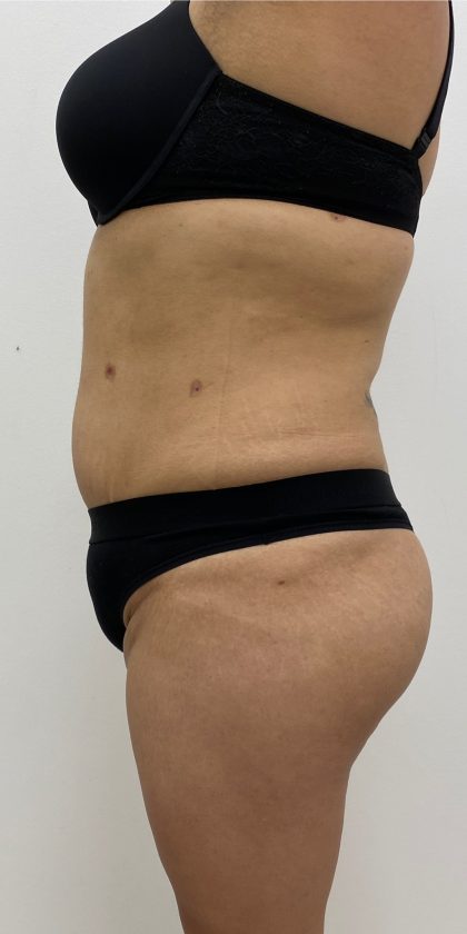 Fat Transfer Before & After Patient #3267