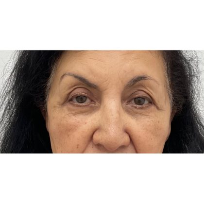 Upper Blepharoplasty Before & After Patient #3297