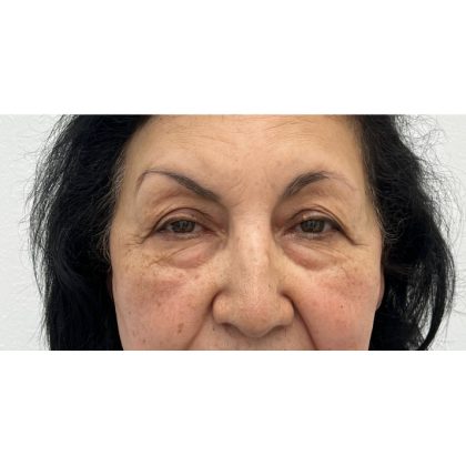 Upper Blepharoplasty Before & After Patient #3297