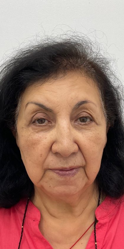 Upper Blepharoplasty Before & After Patient #3297