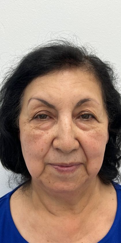 Lower Blepharoplasty Before & After Patient #3297