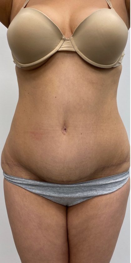 Fat Transfer Before & After Patient #3256