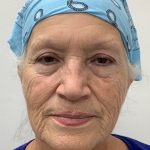 Lower Blepharoplasty Before & After Patient #3302