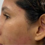 Non-Surgical Rhinoplasty Before & After Patient #3252