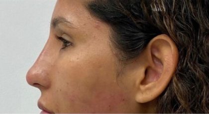 Non-Surgical Rhinoplasty Before & After Patient #3252