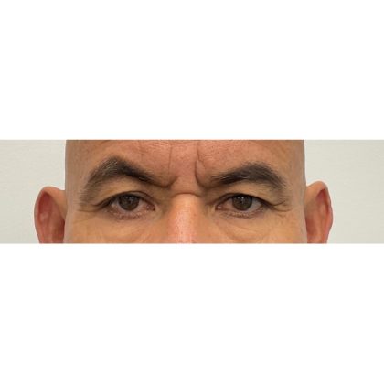 Brow Lift Before & After Patient #3316