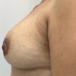 Breast Augmentation Before & After Patient #3360