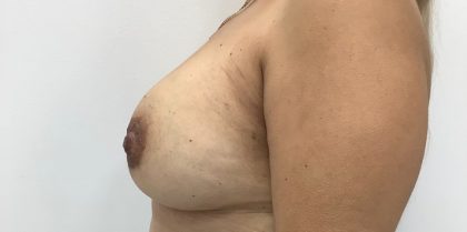 Breast Augmentation Before & After Patient #3360