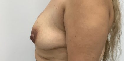 Breast Augmentation Before & After Patient #3360