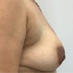 Breast Augmentation Before & After Patient #3360