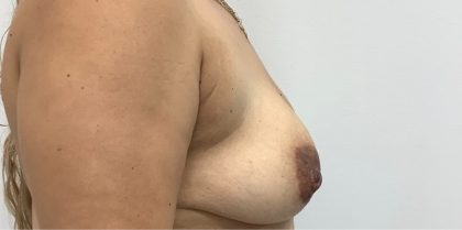 Breast Augmentation Before & After Patient #3360