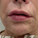 Lip Fillers Before & After Patient #3337