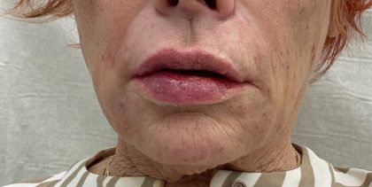 Lip Fillers Before & After Patient #3337