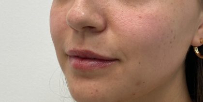 Lip Fillers Before & After Patient #3340