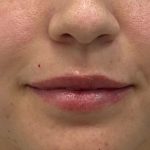 Lip Fillers Before & After Patient #3340