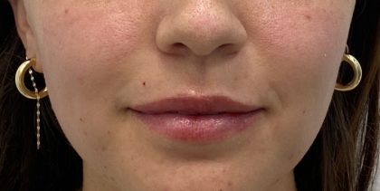 Lip Fillers Before & After Patient #3340