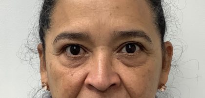 Lower Blepharoplasty Before & After Patient #3351