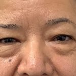 Lower Blepharoplasty Before & After Patient #3349