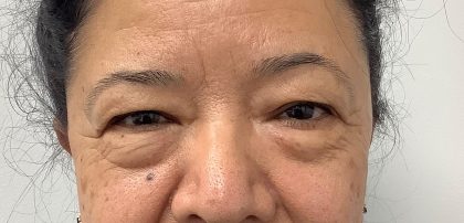 Lower Blepharoplasty Before & After Patient #3349