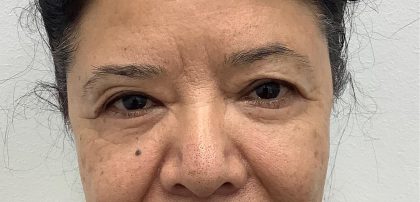 Lower Blepharoplasty Before & After Patient #3349