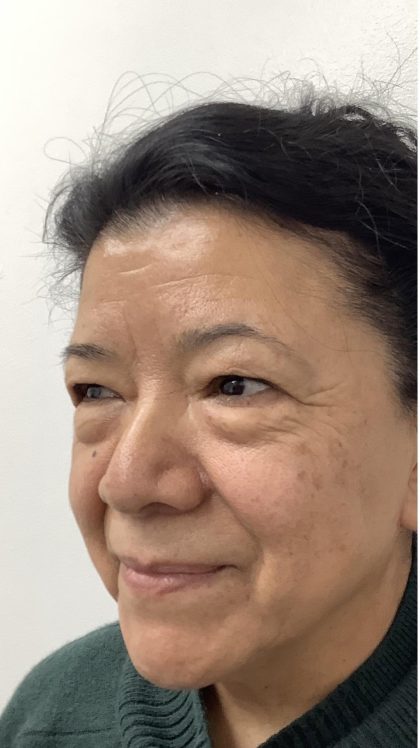 Lower Blepharoplasty Before & After Patient #3349