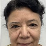 Lower Blepharoplasty Before & After Patient #3349