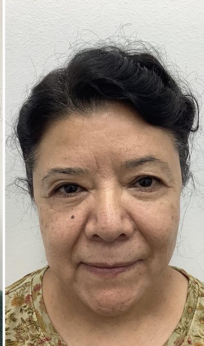 Lower Blepharoplasty Before & After Patient #3349