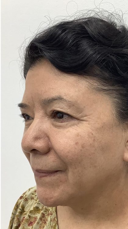 Lower Blepharoplasty Before & After Patient #3349