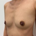 Breast Augmentation Before & After Patient #3389