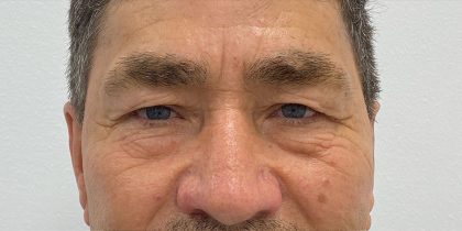 Upper Blepharoplasty Before & After Patient #3394